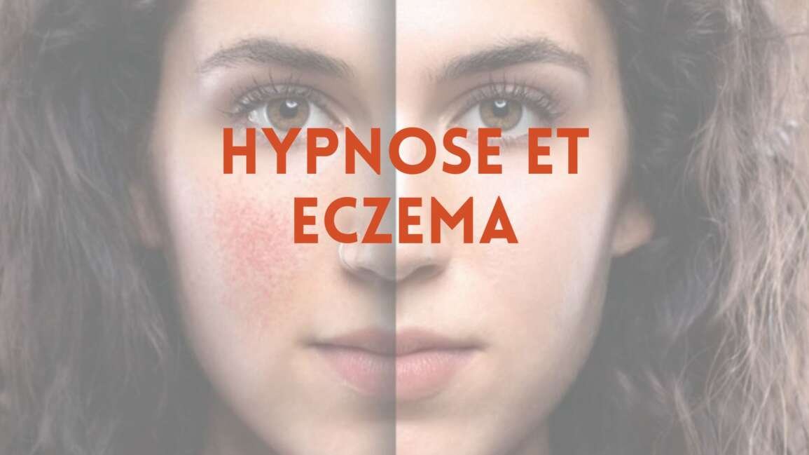 Hypnose et eczéma