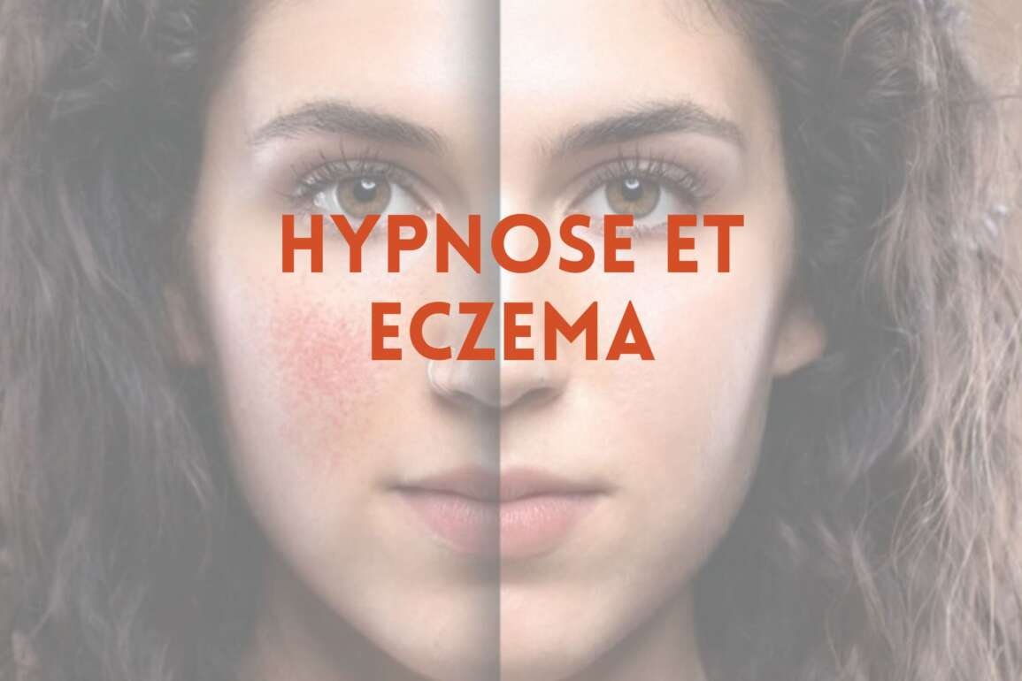 Hypnose et eczéma